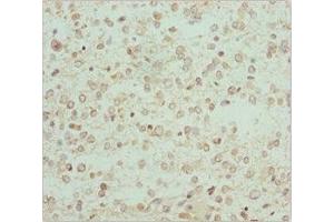 Immunohistochemistry of paraffin-embedded human glioma using ABIN7167743 at dilution of 1:100 (RCN2 Antikörper  (AA 23-180))