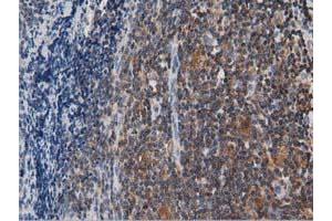 Immunohistochemical staining of paraffin-embedded Human lymphoma tissue using anti-ARHGAP25 mouse monoclonal antibody. (ARHGAP25 Antikörper)