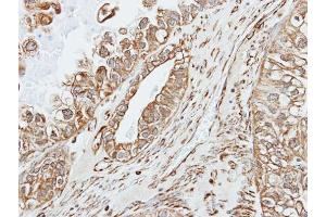 IHC-P Image Immunohistochemical analysis of paraffin-embedded human ovarian cancer, using alpha amylase 2A(pancreatic), antibody at 1:500 dilution. (AMY2A Antikörper)