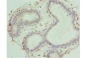 Immunohistochemistry of paraffin-embedded human breast cancer using ABIN7166867 at dilution of 1:100 (PDXK Antikörper  (AA 1-312))