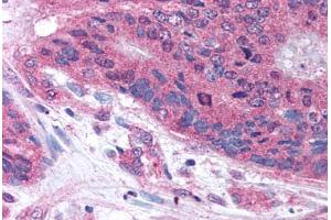 Human Colon Carcinoma (formalin-fixed, paraffin-embedded) stained with PLA2G3 antibody ABIN213634 at 10 ug/ml followed by biotinylated goat anti-rabbit IgG secondary antibody ABIN481713, alkaline phosphatase-streptavidin and chromogen. (PLA2G3 Antikörper  (Internal Region))