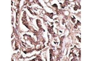 IHC analysis of FFPE human breast carcinoma tissue stained with the APG7 antibody (ATG7 Antikörper  (AA 284-313))