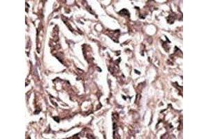 IHC analysis of FFPE human breast carcinoma tissue stained with the APG7 antibody