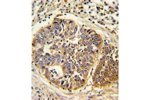 Formalin-fixed and paraffin-embedded human lung carcinoma reacted with HMGCS1 Antibody (C-term), which was peroxidase-conjugated to the secondary antibody, followed by DAB staining. (HMGCS1 Antikörper  (C-Term))