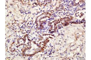 Formalin-fixed and paraffin embedded human lung carcinoma labeled with Rabbit Anti-CD361 Polyclonal Antibody, Unconjugated  at 1:200 followed by conjugation to the secondary antibody and DAB staining