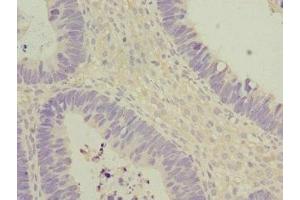 Immunohistochemistry of paraffin-embedded human ovarian cancer using ABIN7172903 at dilution of 1:100 (EIF2B2 Antikörper  (AA 1-351))