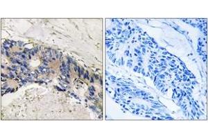 Immunohistochemistry analysis of paraffin-embedded human colon carcinoma tissue, using CA1 Antibody. (CA1 Antikörper  (AA 41-90))