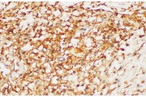 Immunohistochemistry of paraffin-embedded Human kidney cancer using HRAS Polycloanl Antibody at dilution of 1:200 (HRAS Antikörper)