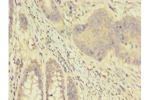 Immunohistochemistry of paraffin-embedded human colon cancer using ABIN7144423 at dilution of 1:100 (Apolipoprotein D Antikörper  (AA 21-189))
