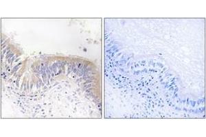Immunohistochemistry analysis of paraffin-embedded human lung carcinoma tissue, using VGF Antibody. (VGF Antikörper  (AA 454-503))