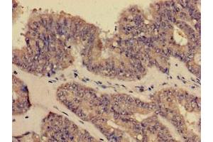 Immunohistochemistry of paraffin-embedded human endometrial cancer using ABIN7148409 at dilution of 1:100 (CD35 Antikörper  (AA 901-1095))
