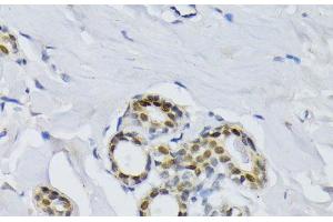 Immunohistochemistry of paraffin-embedded Human breast using BCCIP Polyclonal Antibody at dilution of 1:100 (40x lens). (BCCIP Antikörper)