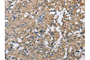 The image on the left is immunohistochemistry of paraffin-embedded Human thyroid cancer tissue using ABIN7128713(CAB39L Antibody) at dilution 1/40, on the right is treated with fusion protein. (CAB39L Antikörper)