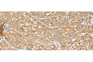 Immunohistochemistry of paraffin-embedded Human liver cancer tissue using C1orf112 Polyclonal Antibody at dilution of 1:110(x200) (C1orf112 Antikörper)