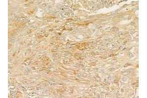 ABIN6257094 and ABIN6275278 at 1/100 staining human lung squamous cell carcinoma by IHC-P. (CYB5R3 Antikörper  (C-Term))