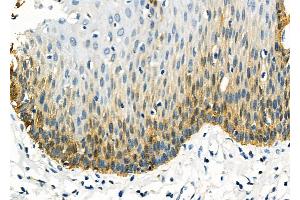 ABIN6259942 and ABIN6277949 at 1/100 staining Human esophageal cancer and adjacent normal tissues by IHC-P. (ANO1 Antikörper  (Internal Region))