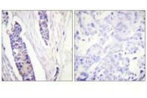 Immunohistochemistry analysis of paraffin-embedded human breast carcinoma tissue, using Tubulin β antibody. (TUBB3 Antikörper  (C-Term))