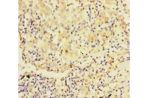 Immunohistochemistry of paraffin-embedded human lung cancer using ABIN7173003 at dilution of 1:100 (TMPRSS11B Antikörper  (AA 201-416))