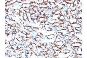 Formalin-fixed, paraffin-embedded human Angiosarcoma stained with Smooth Muscle Actin Monoclonal Antibody (ACTA2/791). (Smooth Muscle Actin Antikörper)