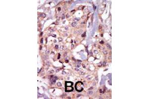Formalin-fixed and paraffin-embedded human cancer tissue reacted with TEC polyclonal antibody  , which was peroxidase-conjugated to the secondary antibody, followed by AEC staining. (NR4A3 Antikörper  (Internal Region))
