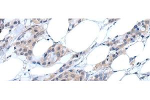 Immunohistochemistry of paraffin-embedded Human breast cancer tissue using ANGPTL6 Polyclonal Antibody at dilution of 1:55(x200) (ANGPTL6 Antikörper)