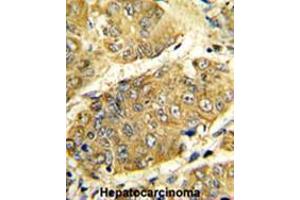 Formalin-fixed and paraffin-embedded human hepatocarcinoma reacted with LTA Antibody (Center), which was peroxidase-conjugated to the secondary antibody, followed by DAB staining.