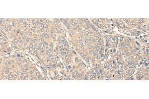 Immunohistochemistry of paraffin-embedded Human liver cancer tissue using C1orf106 Polyclonal Antibody at dilution of 1:80(x200) (C1ORF106 Antikörper)