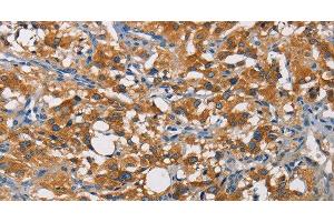 Immunohistochemistry of paraffin-embedded Human thyroid cancer tissue using CRTAM Polyclonal Antibody at dilution of 1:60 (CRTAM Antikörper)