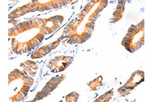 The image on the left is immunohistochemistry of paraffin-embedded Human colon cancer tissue using ABIN7192286(SCNN1A Antibody) at dilution 1/30, on the right is treated with synthetic peptide. (SCNN1A Antikörper)