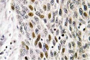 Immunohistochemistry (IHC) analyzes of ATF-1 antibody in paraffin-embedded human lung carcinoma tissue. (AFT1 Antikörper)