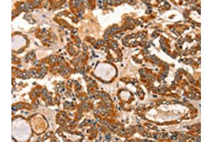 The image on the left is immunohistochemistry of paraffin-embedded Human thyroid cancer tissue using ABIN7129834(IKZF3 Antibody) at dilution 1/60, on the right is treated with fusion protein. (IKZF3 Antikörper)