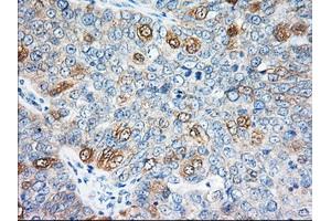 Immunohistochemical staining of paraffin-embedded Adenocarcinoma of Human colon tissue using anti-EIF2S1 mouse monoclonal antibody. (EIF2S1 Antikörper)