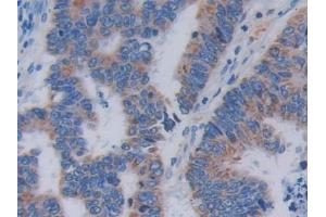 Detection of TOP3 in Human Colorectal cancer Tissue using Polyclonal Antibody to Topoisomerase III (TOP3)