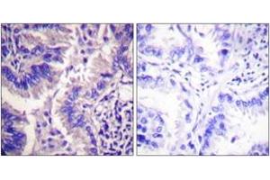 Immunohistochemistry analysis of paraffin-embedded human lung carcinoma tissue, using Caspase 9 (Cleaved-Asp315) Antibody. (Caspase 9 Antikörper  (Cleaved-Asp315))