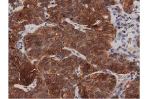 Immunohistochemical staining of paraffin-embedded Adenocarcinoma of Human breast tissue using anti-DNAJA2 mouse monoclonal antibody. (DNAJA2 Antikörper)