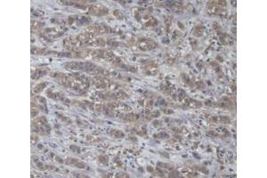 Detection of a4GALT in Human Breast Cancer Tissue using Polyclonal Antibody to Alpha-1,4-Galactosyltransferase (a4GALT) (A4GALT Antikörper  (AA 44-353))