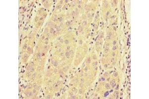 Immunohistochemistry of paraffin-embedded human liver cancer using ABIN7168958 at dilution of 1:100 (SRRM2 Antikörper  (AA 248-462))