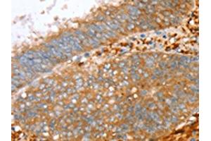 The image on the left is immunohistochemistry of paraffin-embedded Human cervical cancer tissue using ABIN7130778(PTPN7 Antibody) at dilution 1/30, on the right is treated with fusion protein. (PTPN7 Antikörper)