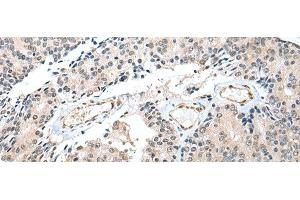 Immunohistochemistry of paraffin-embedded Human prost at e cancer tissue using S100A16 Polyclonal Antibody at dilution of 1:25(x200) (S100A16 Antikörper)