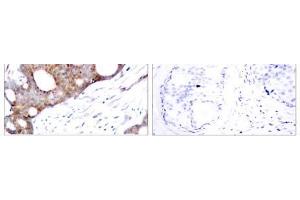 Immunohistochemical analysis of paraffin- embedded human breast carcinoma tissue using GSK3α (phospho-Ser21) antibody (E011007). (GSK3 alpha Antikörper  (pSer21))