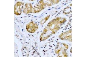 Immunohistochemical analysis of SMYD4 staining in human stomach cancer formalin fixed paraffin embedded tissue section. (SMYD4 Antikörper)