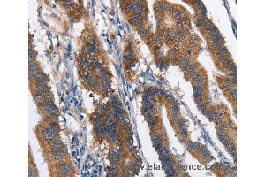 Immunohistochemistry of Human lung cancer using MAD2L1BP Polyclonal Antibody at dilution of 1:60 (MAD2L1BP Antikörper)