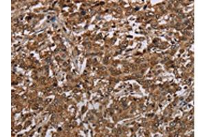 The image on the left is immunohistochemistry of paraffin-embedded Human liver cancer tissue using ABIN7192743(TBX5 Antibody) at dilution 1/35, on the right is treated with synthetic peptide. (T-Box 5 Antikörper)