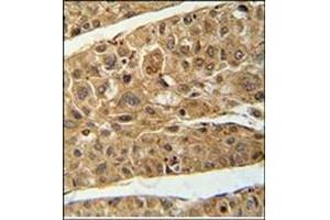 Immunohistochemistry analysis in Formalin Fixed and Paraffin Embedded Human hepatocarcinoma using RT4I1 Antibody (C-term) followed by peroxidase conjugation of the secondary antibody and DAB staining.