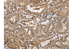 The image on the left is immunohistochemistry of paraffin-embedded Human thyroid cancer tissue using ABIN7191987(PPP2R3A Antibody) at dilution 1/30, on the right is treated with synthetic peptide. (PPP2R3A Antikörper)