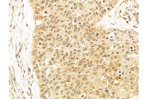 ABIN6263806 and ABIN6273061 at 1/100 staining Human esophageal cancer by IHC-P. (OIP5 Antikörper  (C-Term))