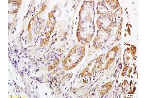 Formalin-fixed and paraffin embedded human lung carcinoma labeled with Rabbit Anti NALP4 Polyclonal Antibody, Unconjugated (ABIN872353) at 1:200 followed by conjugation to the secondary antibody and DAB staining (NLRP4 Antikörper  (AA 351-450))