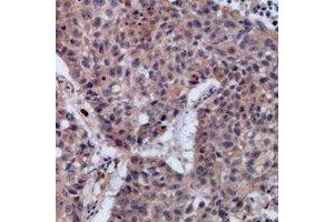 Immunohistochemical analysis of SETMAR staining in human lung cancer formalin fixed paraffin embedded tissue section. (SETMAR Antikörper)