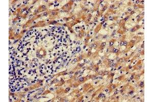Immunohistochemistry of paraffin-embedded human liver cancer using ABIN7142472 at dilution of 1:100 (ALDH9A1 Antikörper  (AA 12-144))