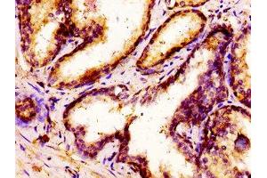 IHC image of ABIN7155804 diluted at 1:300 and staining in paraffin-embedded human prostate cancer performed on a Leica BondTM system. (MSX1 Antikörper  (AA 19-179))